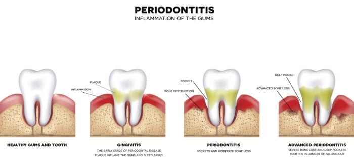 periodontal therapy destrehan la 