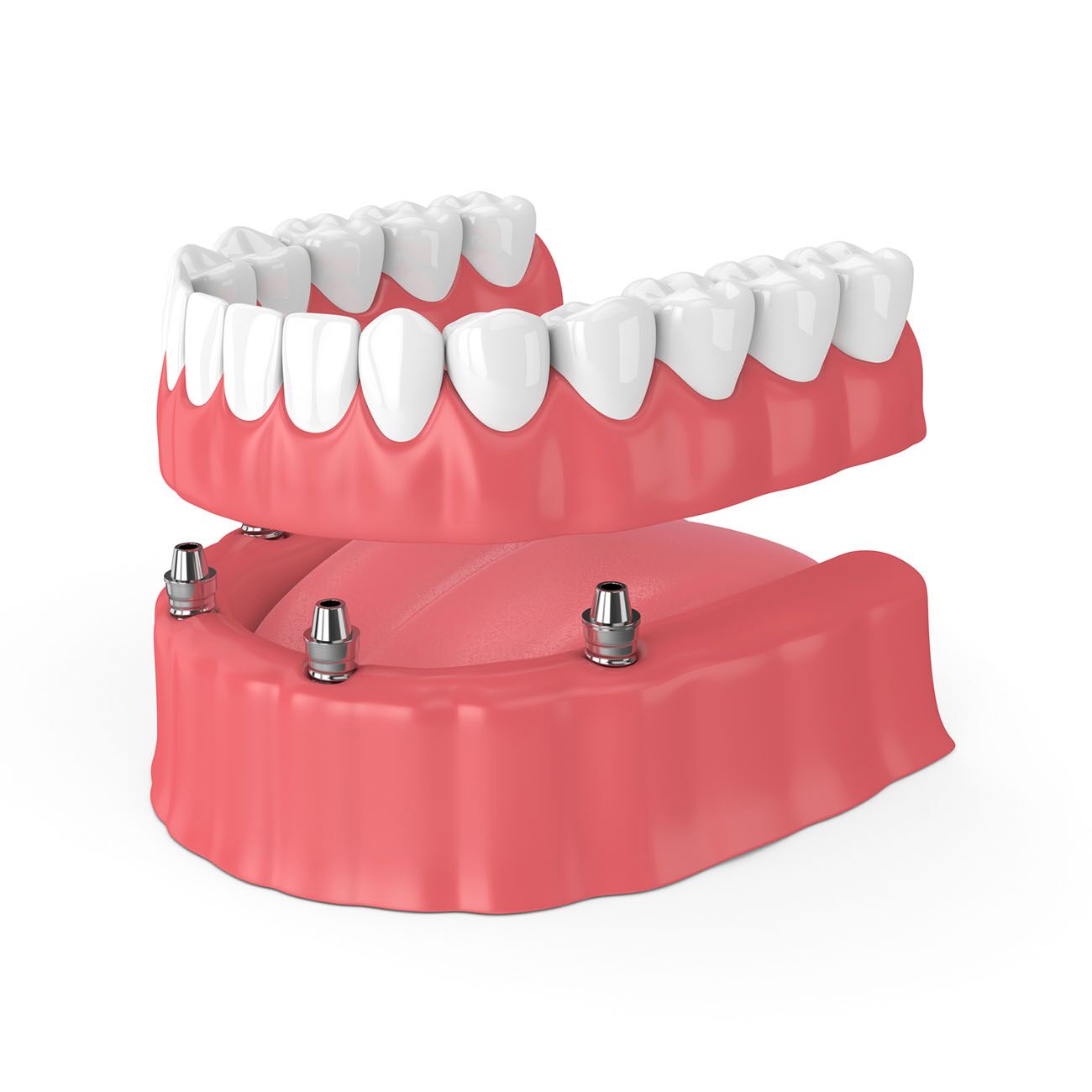 Why to Choose Implant-Supported Dentures