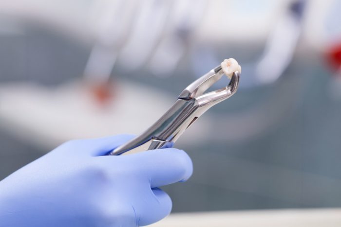 Image of a forceps holding a tooth from an extraction dentist in Destrehan Louisiana
